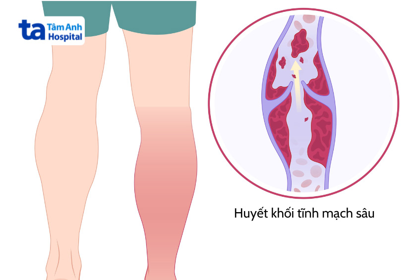 Hình ảnh minh họa thuyên tắc huyết khối tĩnh mạch sau sinh