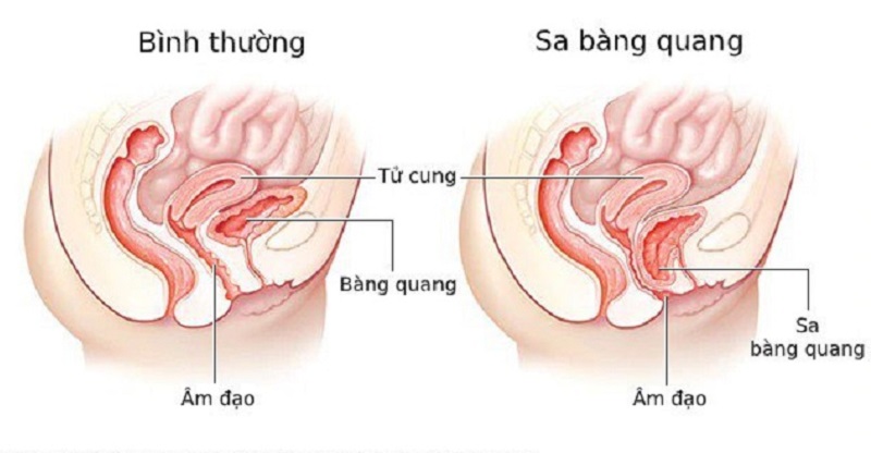 Sa Bàng Quang: Tìm Hiểu Từ Nguyên Nhân Đến Cách Điều Trị 8 Mức độ sa bàng quang