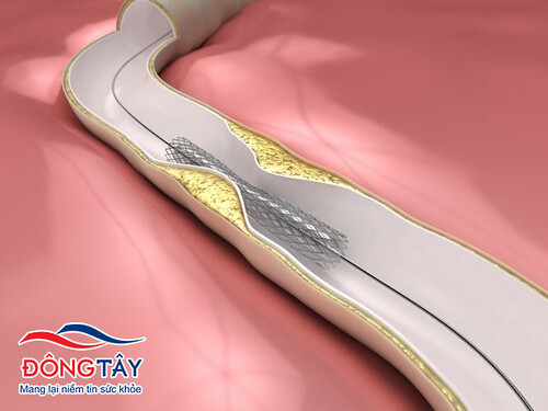 Stent trong lòng động mạch vành