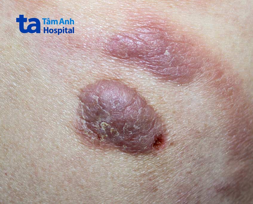 Tổn thương Mycosis Fungoides thực tế