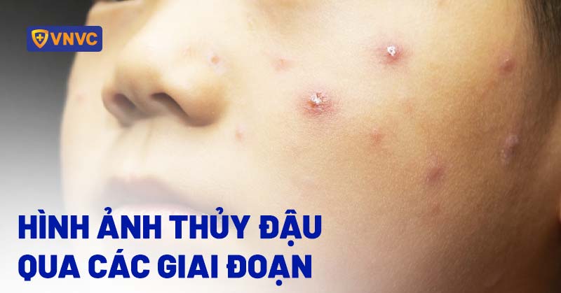 Ảnh minh họa mụn nước thủy đậu