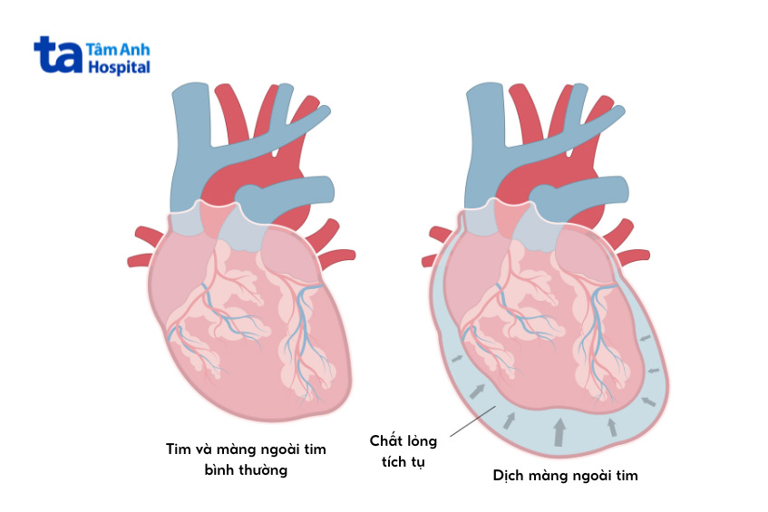 Chèn Ép Tim Cấp: Nguyên Nhân, Dấu Hiệu, Chẩn Đoán và Điều Trị 7 Hình ảnh tim bình thường và tim có dịch màng ngoài tim