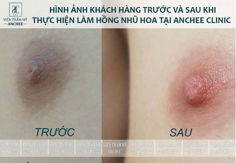 Làm Hồng Nhũ Hoa và Vùng Kín: Các Phương Pháp Hiệu Quả, An Toàn Nhất Hiện Nay 5 Làm hồng nhũ hoa và vùng kín bằng laser