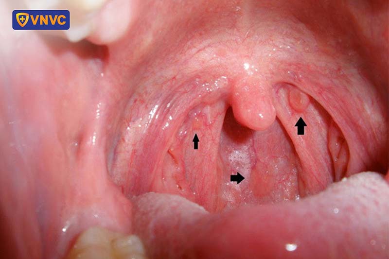 Hình ảnh ung thư vòm họng giai đoạn đầu