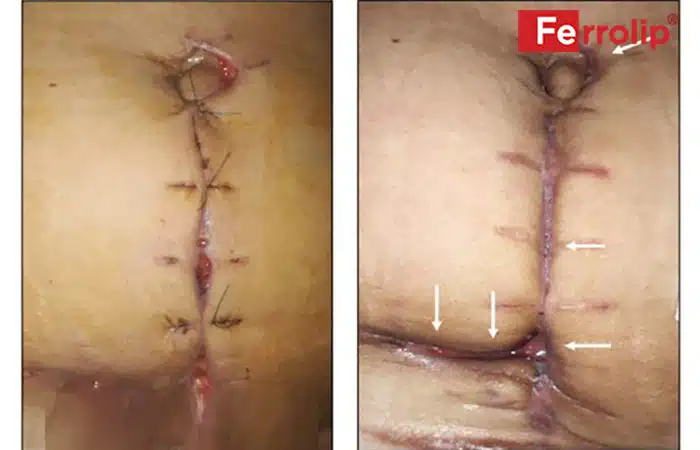 Vết khâu tầng sinh môn bị nhiễm trùng nhẹ