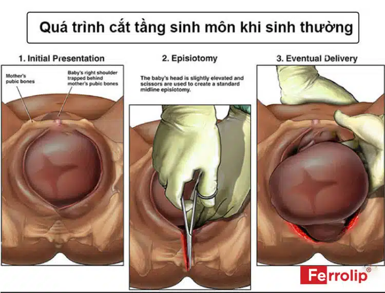 Hình ảnh tầng sinh môn sau khi khâu