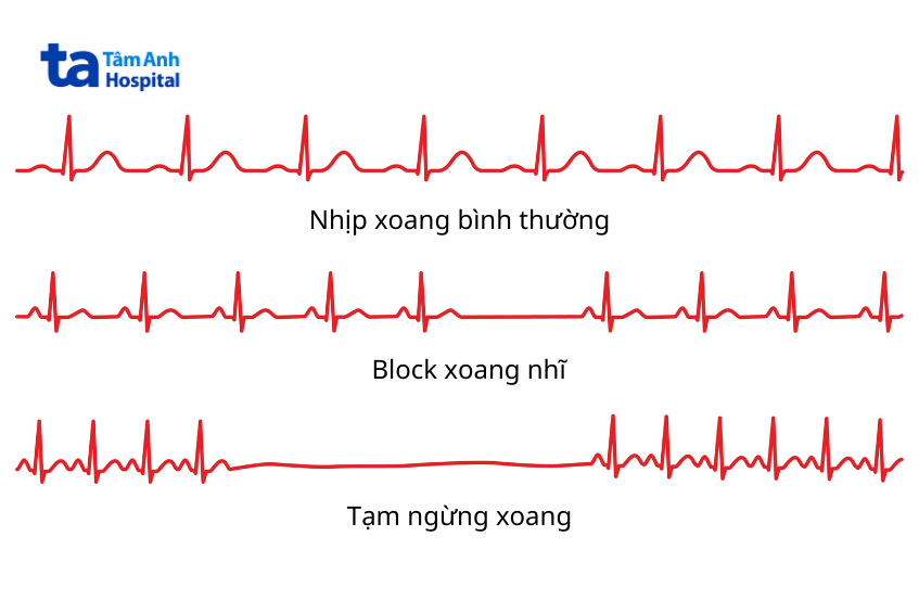 Block xoang nhĩ: Triệu chứng, nguyên nhân và phương pháp điều trị hiệu quả 8 Hình minh họa ECG biểu hiện block xoang nhĩ
