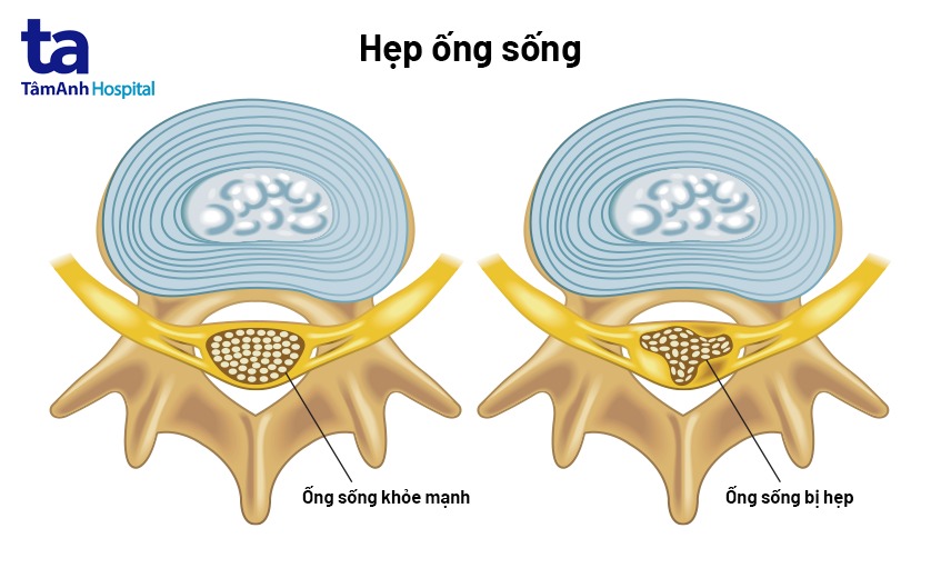 hình ảnh hẹp ống sống