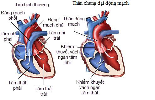 Hình ảnh bệnh nhi tại bệnh viện Nhi Đồng điều trị thân chung động mạch