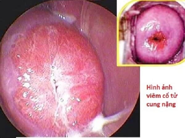 So sánh viêm cổ tử cung