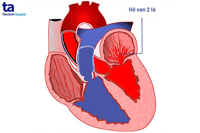 Cấu tạo và hoạt động van hai lá