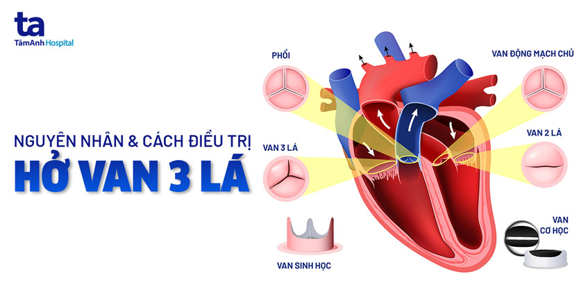 Hình ảnh minh họa van ba lá bị hở
