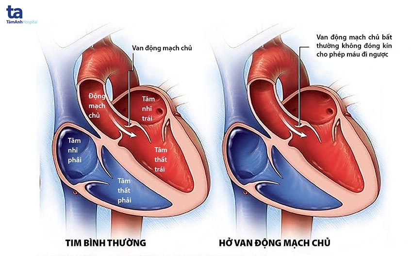 Hở Van Động Mạch Chủ Là Gì? Nguyên Nhân, Triệu Chứng Và Hướng Điều Trị 7 Cấu tạo van động mạch chủ