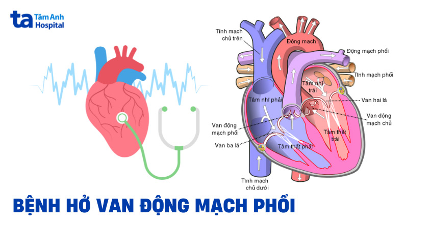 Hình ảnh van động mạch phổi