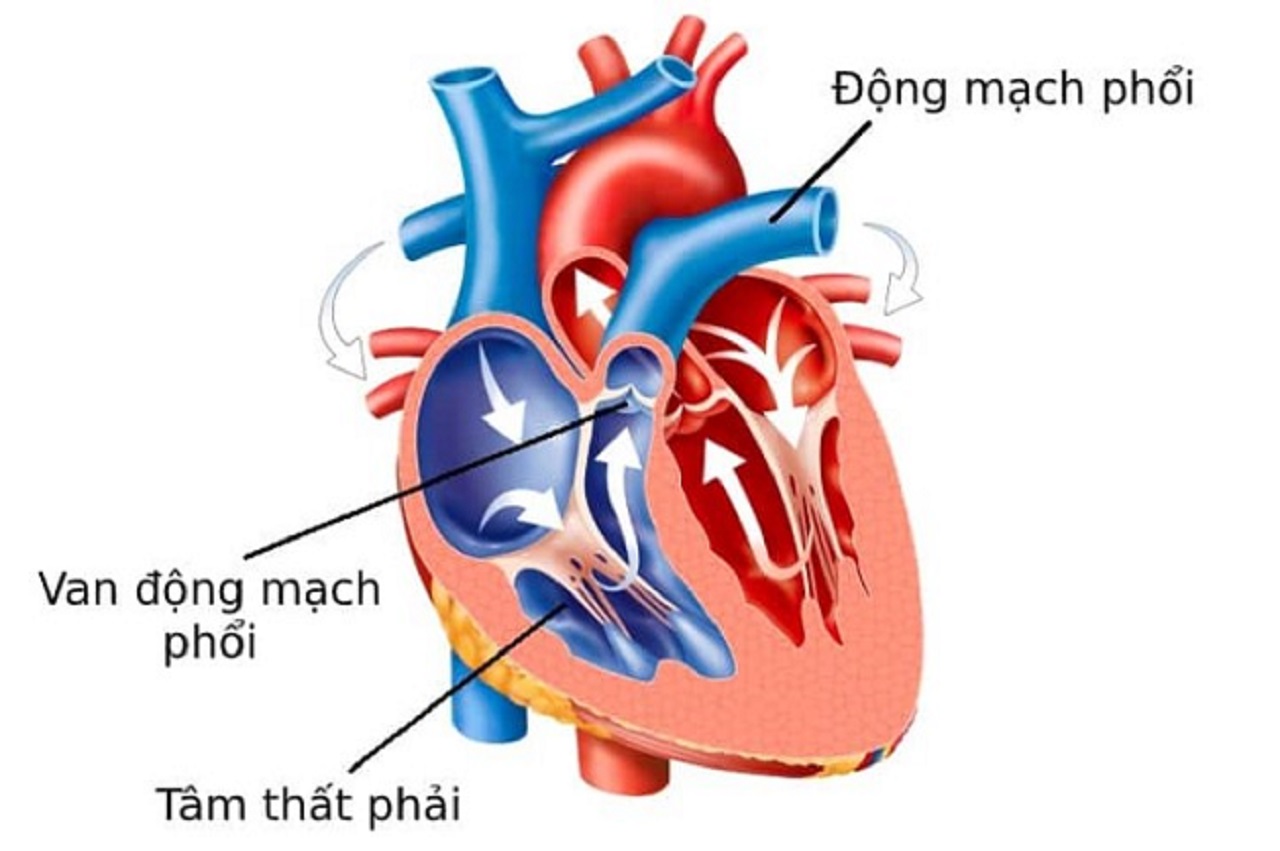 Triệu chứng nhẹ hở van động mạch phổi