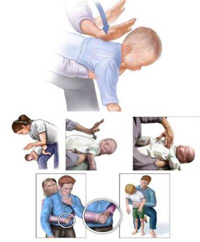 Dị vật khí quản - phế quản