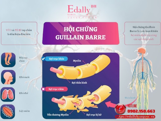 Hội chứng Guillain-Barré