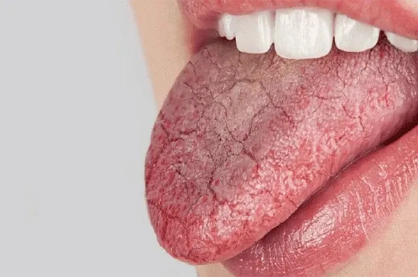 Triệu chứng Sjogren