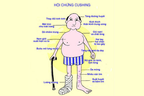 Triệu chứng điển hình bệnh Cushing