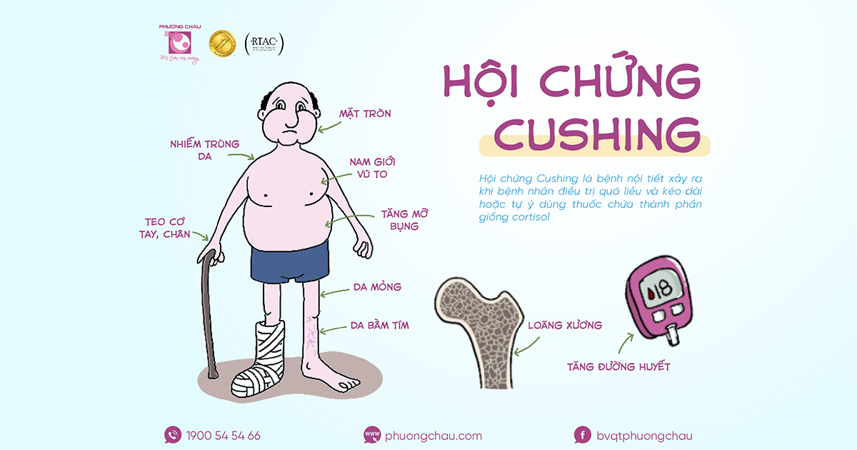 Hội chứng Cushing là gì?