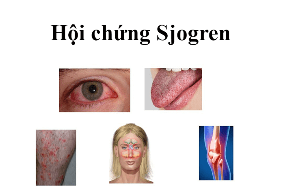 Hội chứng Sjogren là gì