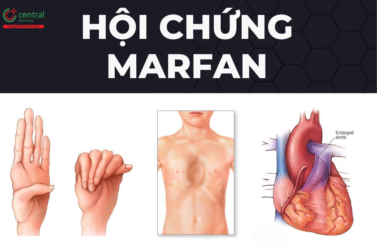 Biểu hiện cơ xương hội chứng Marfan