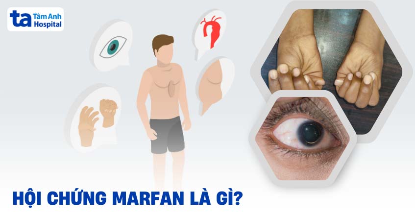 Hội chứng Marfan