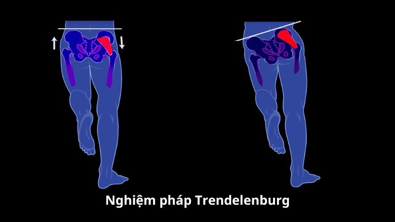 Ngồi lâu gây hội chứng mông chết