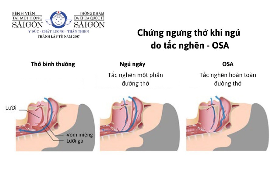 Hình ảnh minh họa OSA