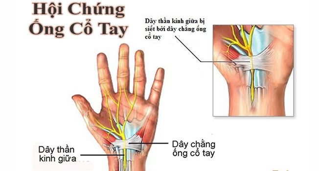 Hội chứng ống cổ tay: Nguyên nhân, triệu chứng và cách điều trị hiệu quả 8 Triệu chứng tê tay do hội chứng ống cổ tay