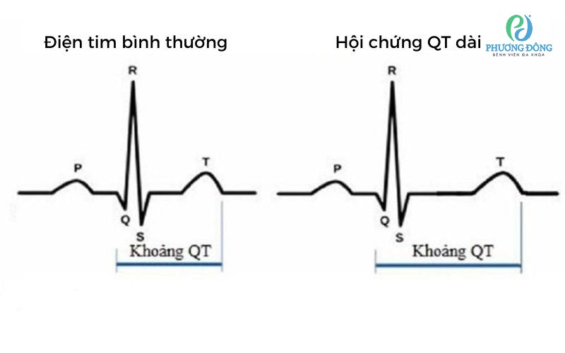 Hội chứng QT dài bẩm sinh: Nguyên nhân, triệu chứng và cách điều trị hiệu quả 7 Hình ảnh minh họa ECG hội chứng QT dài