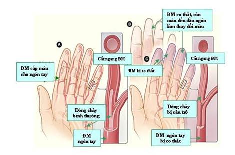 Cảm giác lạnh ở tay chân: Nguyên nhân, dấu hiệu và cách xử lý 8 Hội chứng Raynaud gây tay chân lạnh