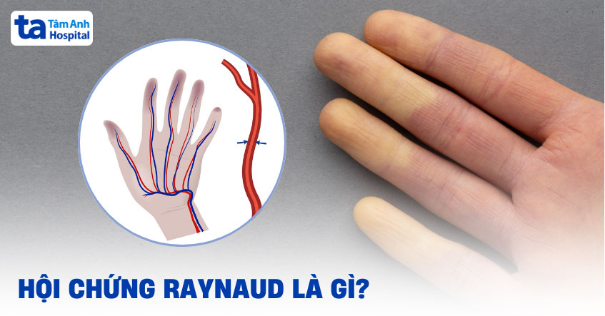 Hiện tượng Raynaud (đầu ngón tay trắng bệch, tím tái khi gặp lạnh) 8 Ngón tay trắng bệch do Raynaud