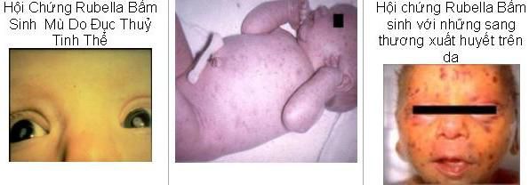 bien-chung-rubella-thai-ky
