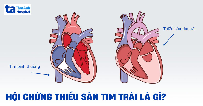 Cấu trúc tim bị thiểu sản trái