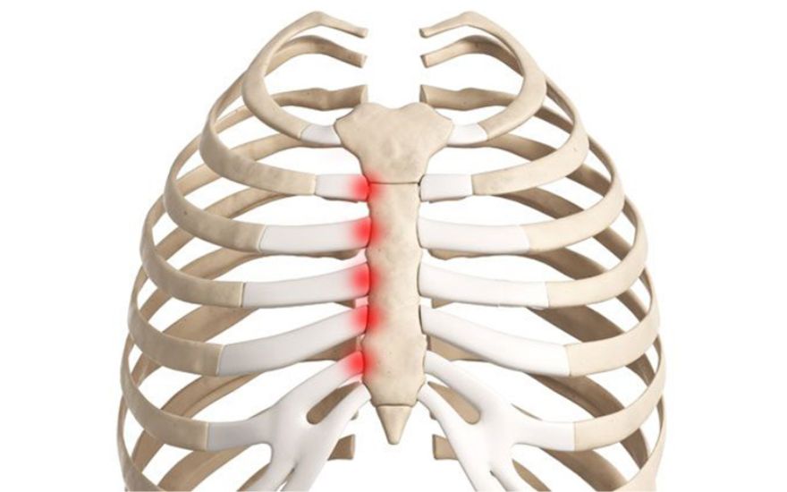 Vị trí viêm sụn sườn – Hội chứng Tietze