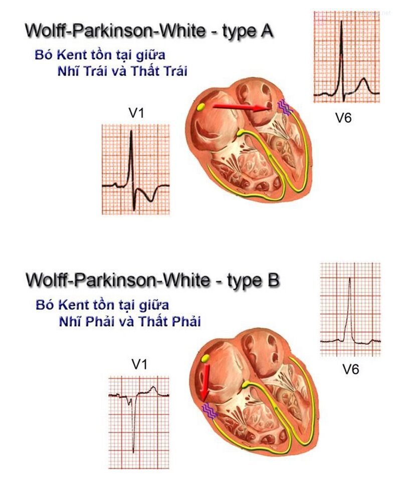 Hội chứng WPW không triệu chứng ở người trẻ – Ảnh minh họa