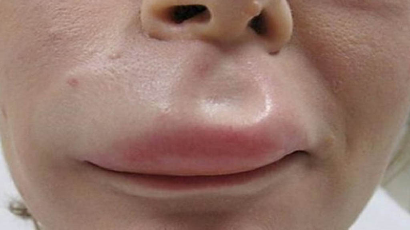 Triệu chứng dị ứng miệng