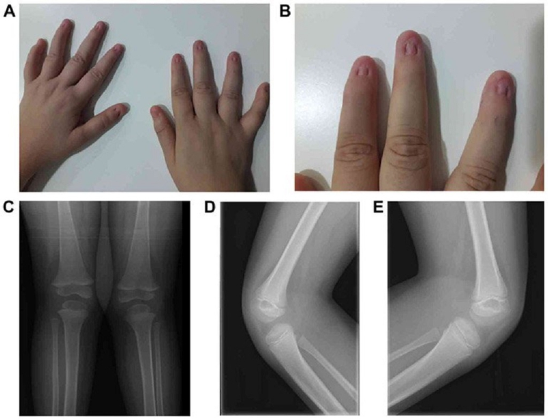 Triệu chứng móng tay trong hội chứng móng xương bánh chè
