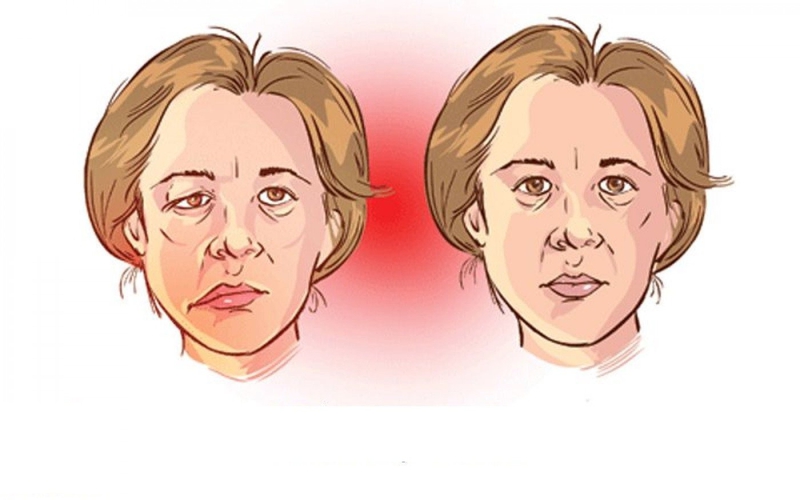 Hội chứng Lambert-Eaton - yếu cơ tự miễn
