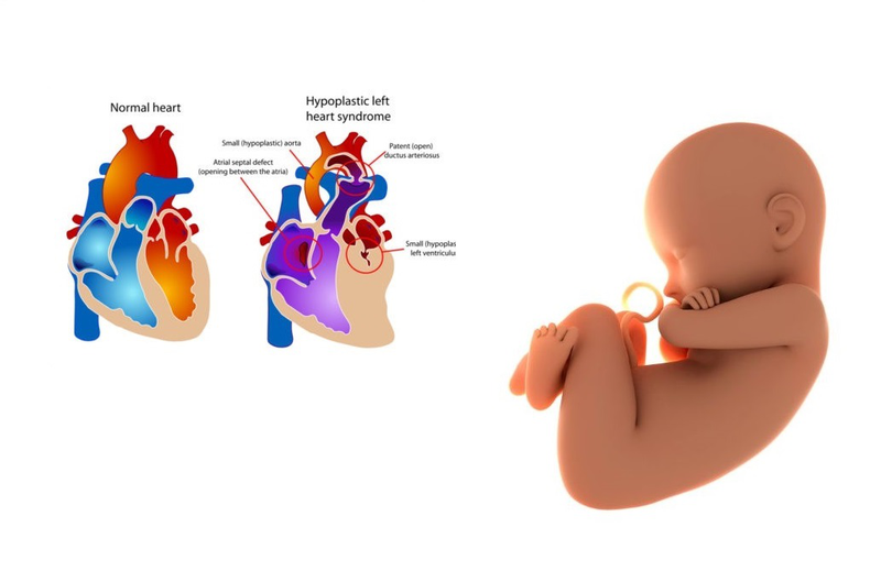 Siêu âm tim chẩn đoán HLHS