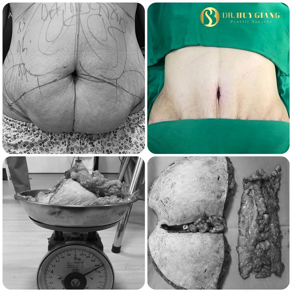 Hút mỡ tạo hình thành bụng