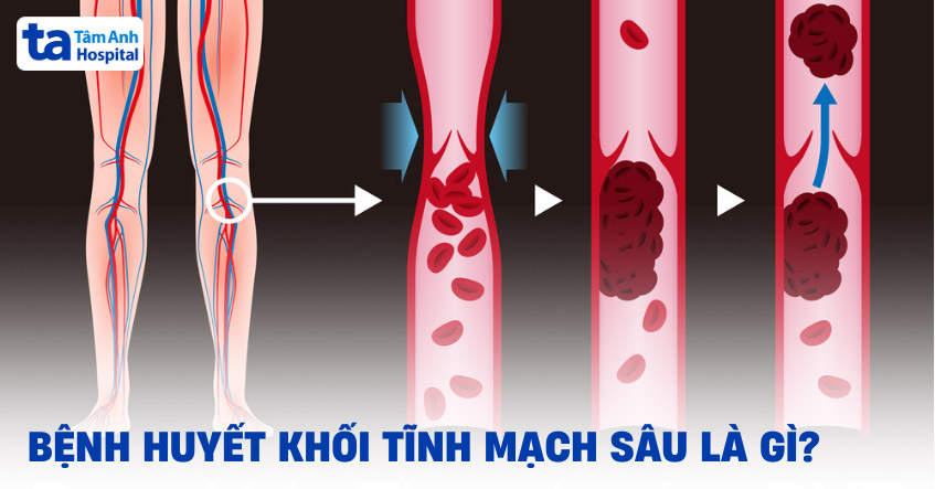 Huyết khối tĩnh mạch - nguyên nhân chính gây thuyên tắc phổi
