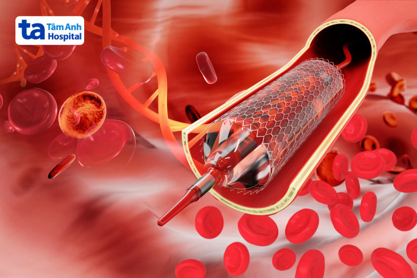 Huyết khối cấp tính trong stent