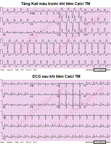 ECG tăng kali máu