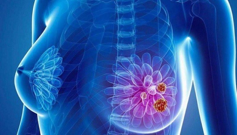Ung Thư Vú: Hiểu Rõ, Phát Hiện Sớm và Điều Trị Hiệu Quả 2 image 101