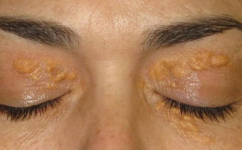 U Vàng: Dấu Hiệu Cảnh Báo Rối Loạn Mỡ Máu và Nguy Cơ Tim Mạch 2 image 108