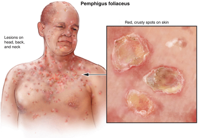 Pemphigus Da Mỡ: Bệnh Da Bóng Nước Hiếm Gặp Và Những Điều Cần Biết 2 image 117