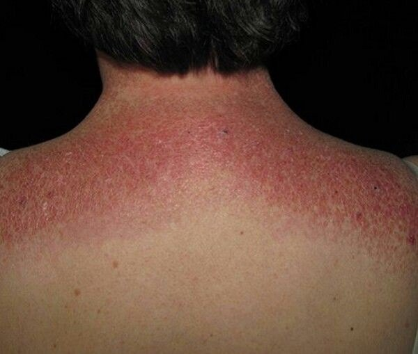 Viêm bì cơ: Hiểu đúng để nhận biết và điều trị hiệu quả 2 image 119