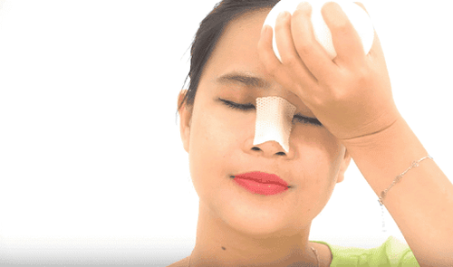 Cẩm Nang Chăm Sóc Chi Tiết 7 Ngày Đầu Sau Nâng Mũi Để Mũi Nhanh Hồi Phục, Đẹp Chuẩn Form 2 image 124
